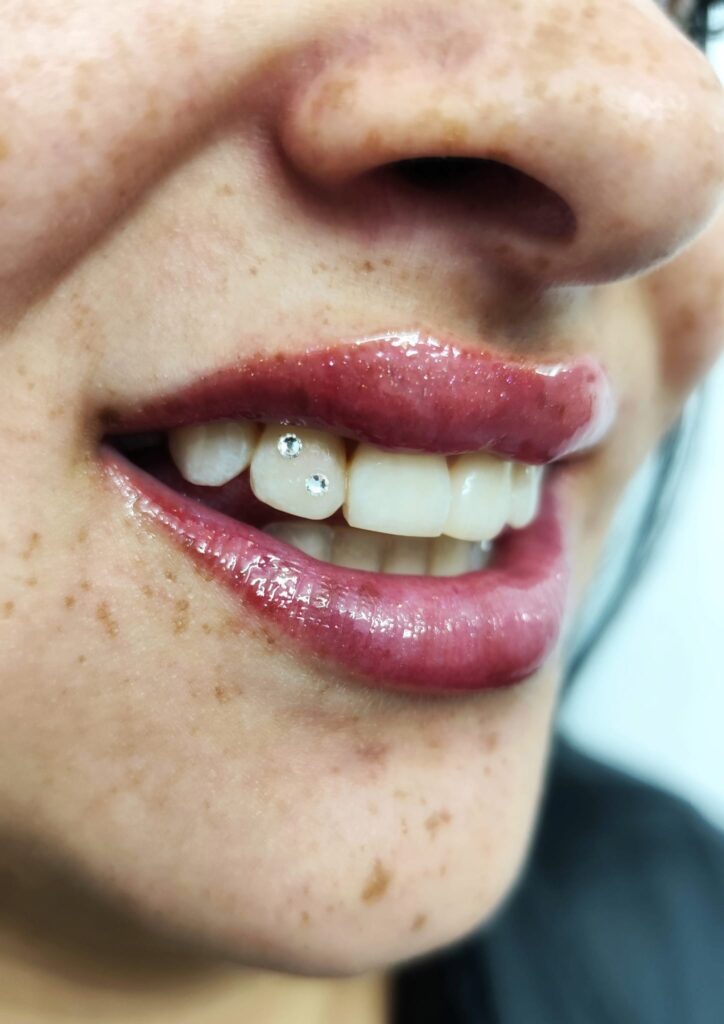 Gemas dentales en sonrisa realizadas por Anaís López